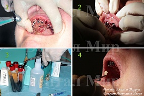 Фото этапов имплантации зубов по шаблону