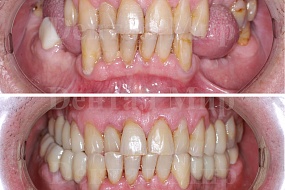 Фото до и после имплантации зубов
