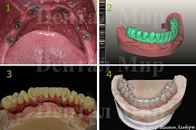 Имплантаты нижней челюсти; 3D моделирование; Mockup; Керамический мостовидный протез на имплантатах
