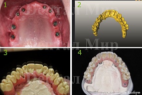 Имплантаты верхней челюсти; 3D моделирование; Mockup; Керамический мостовидный протез на имплантатах
