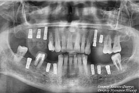 Фото ОПТГ после имплантации зубов