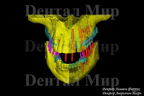 3D моделирование имплантации зубов